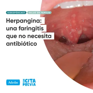 Herpangina: una faringitis que no necesita antibiótico